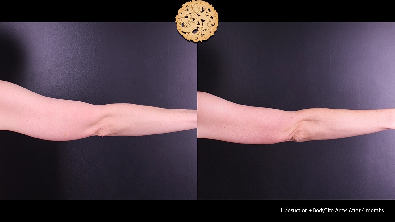 BodyTite Before & After