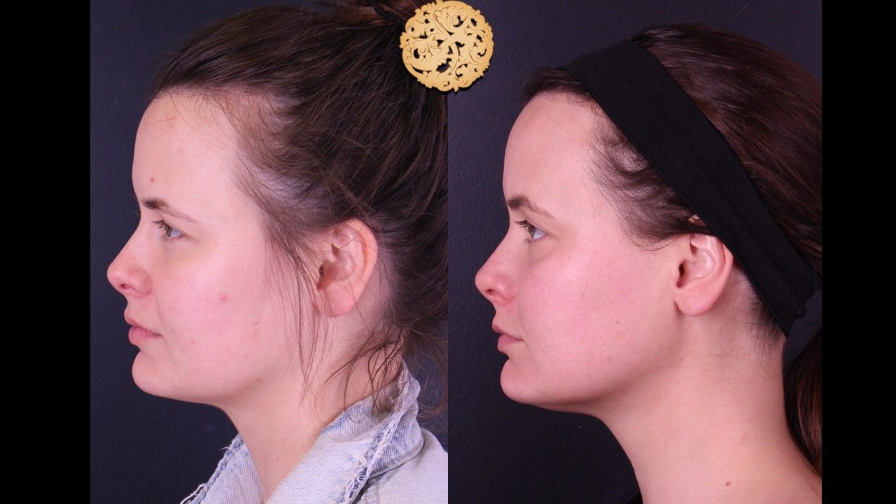 Gold Tip Facial Before & After