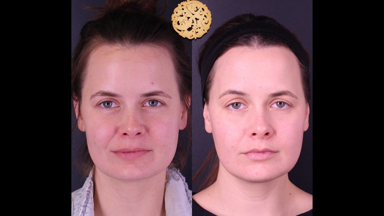 Gold Tip Facial Before & After