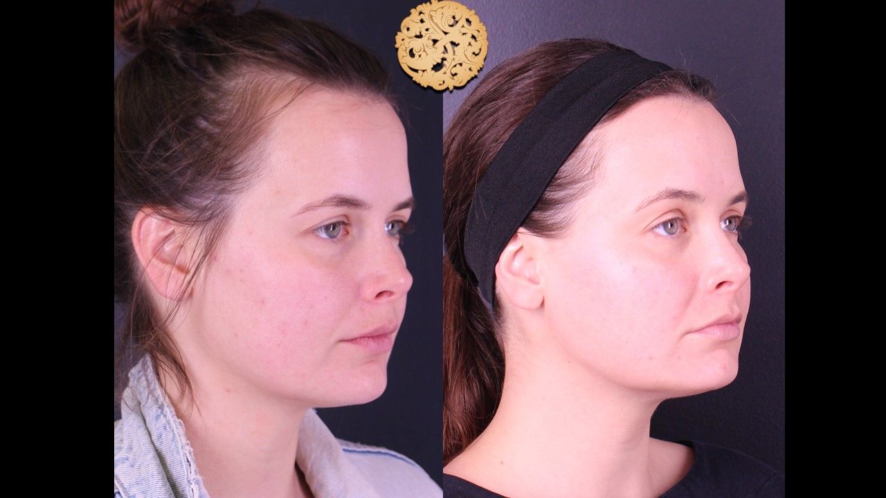 Gold Tip Facial Before & After