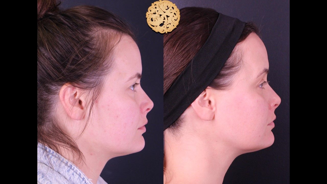 Gold Tip Facial Before & After