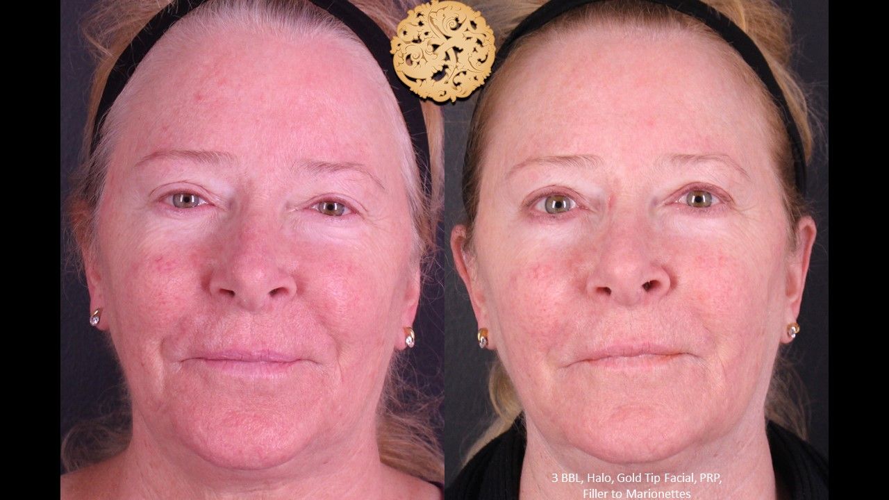 Gold Tip Facial Before & After