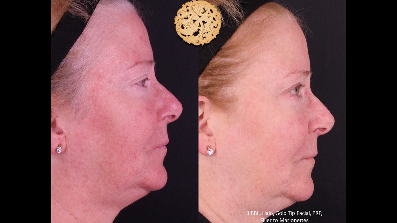 Gold Tip Facial Before & After