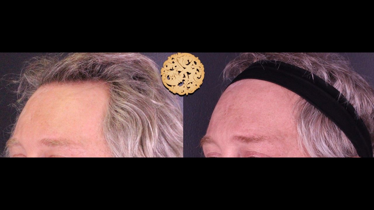 Facial Fat Transfer Forehead Before & After