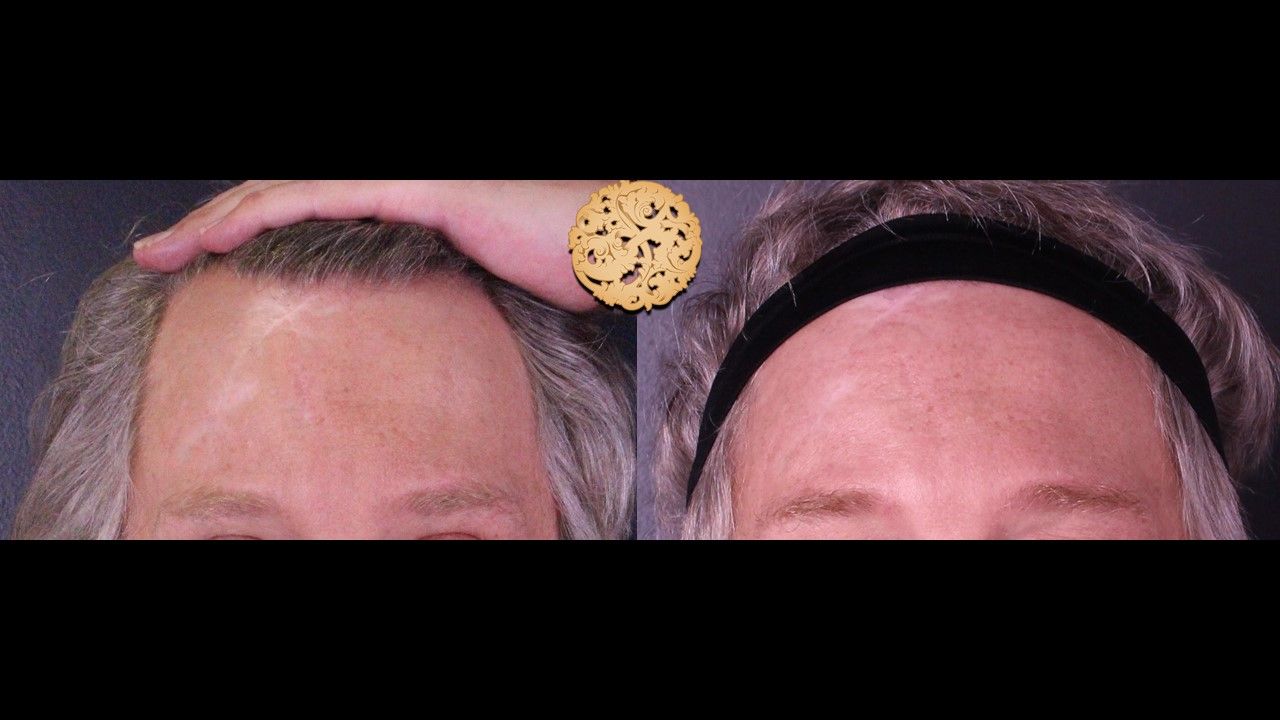 Facial Fat Transfer Forehead Before & After