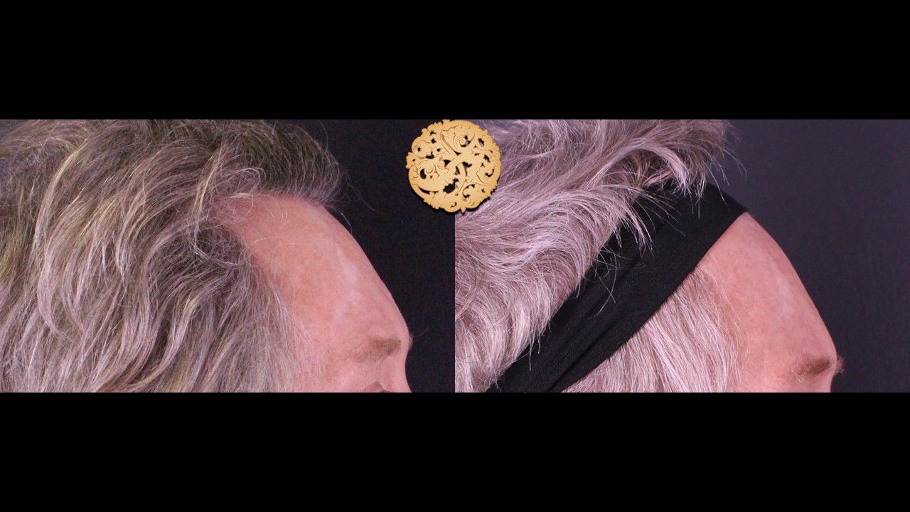 Facial Fat Transfer Forehead Before & After