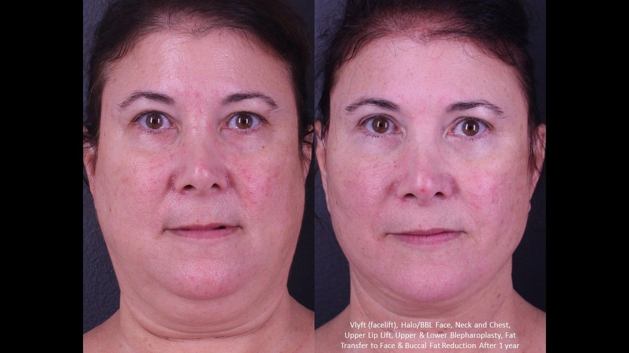 Facial Fat Transfer Forehead Before & After