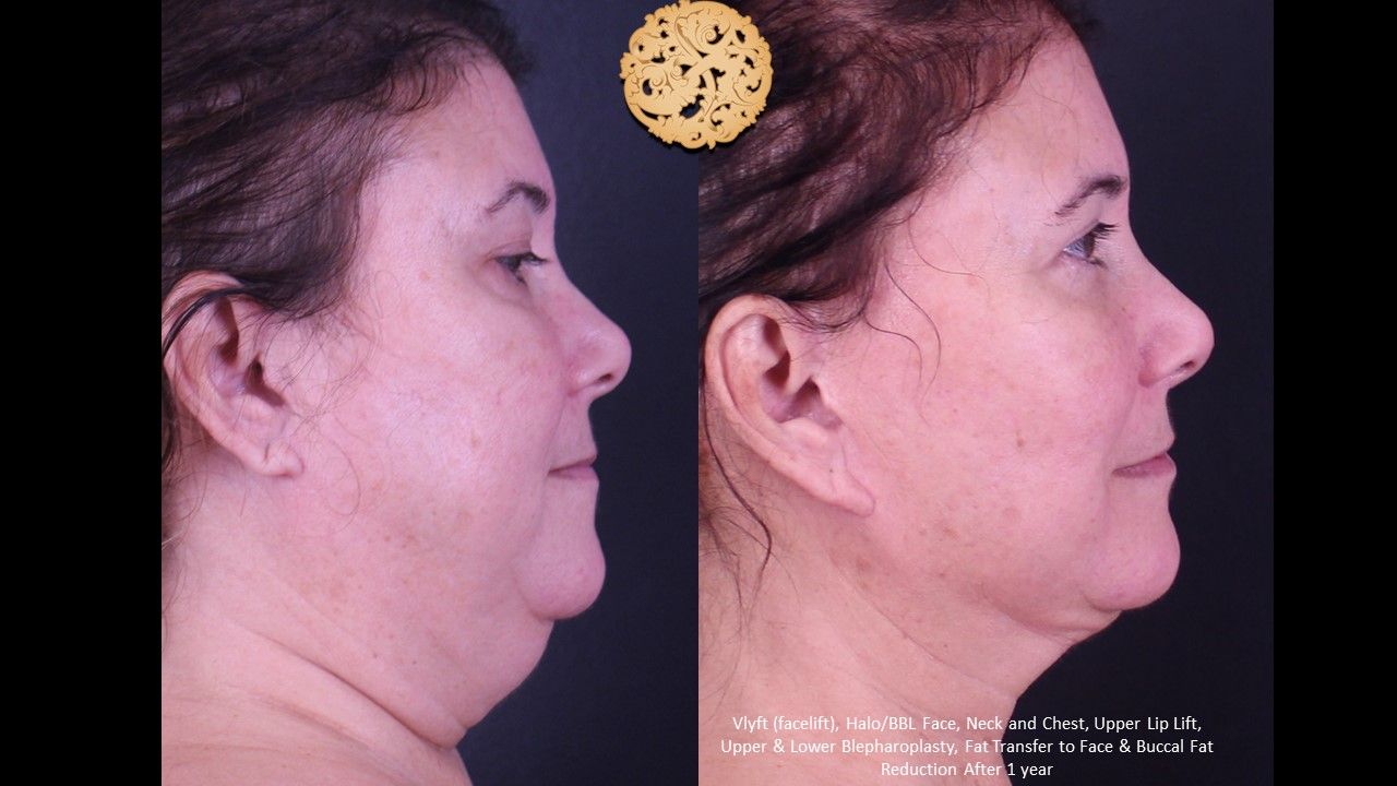 Facial Fat Transfer Forehead Before & After
