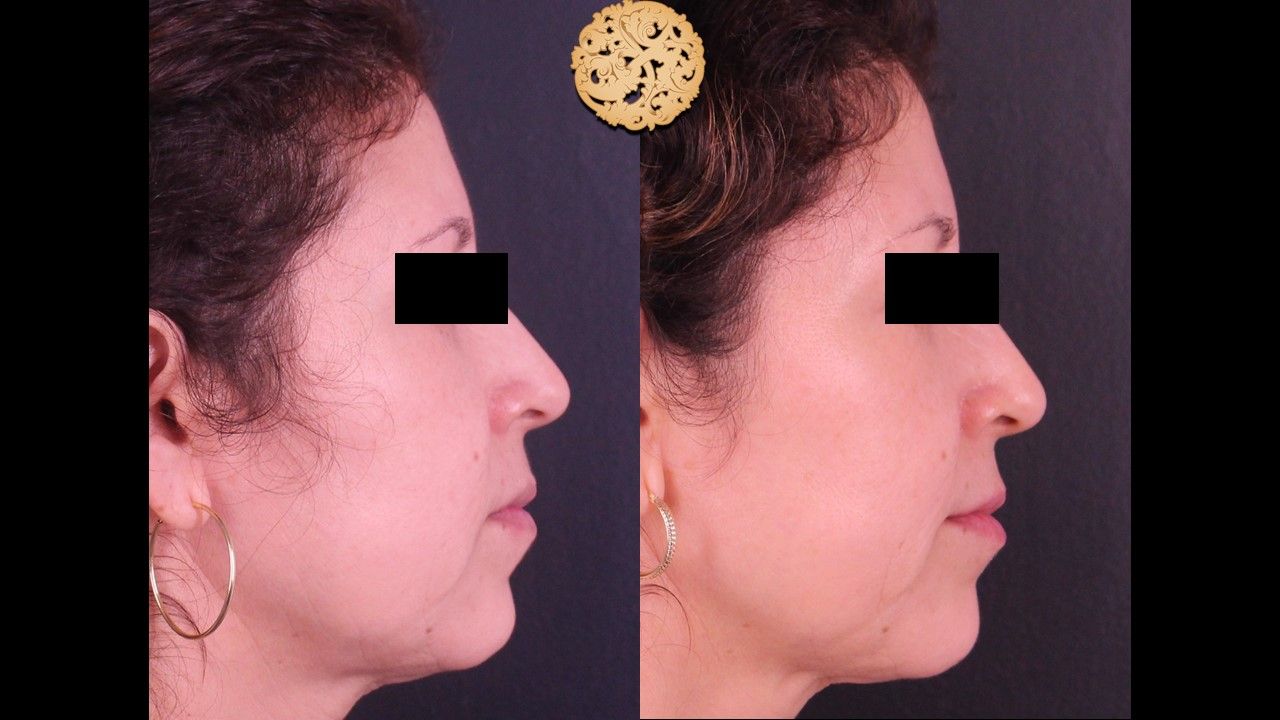 Genesis Before & After