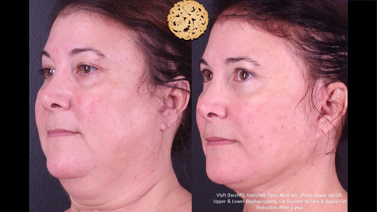 HALO Before & After