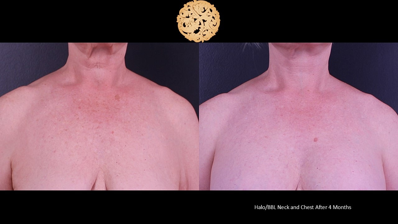 HALO Before & After
