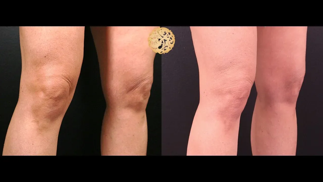 Morpheus8 Before & After