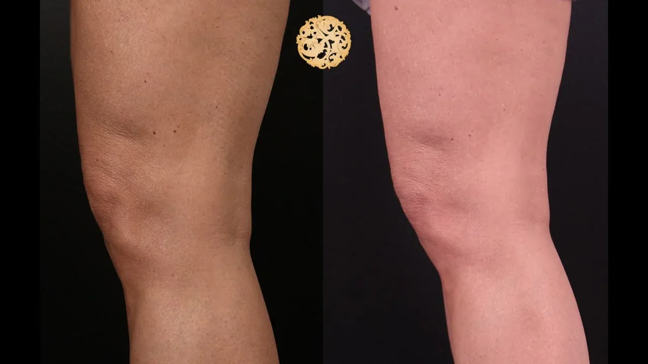 Morpheus8 Before & After