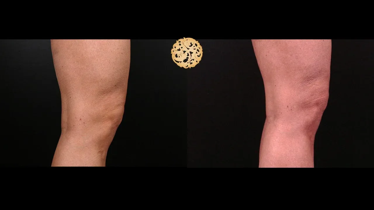 Morpheus8 Before & After