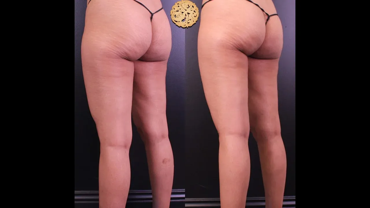 Morpheus8 Before & After