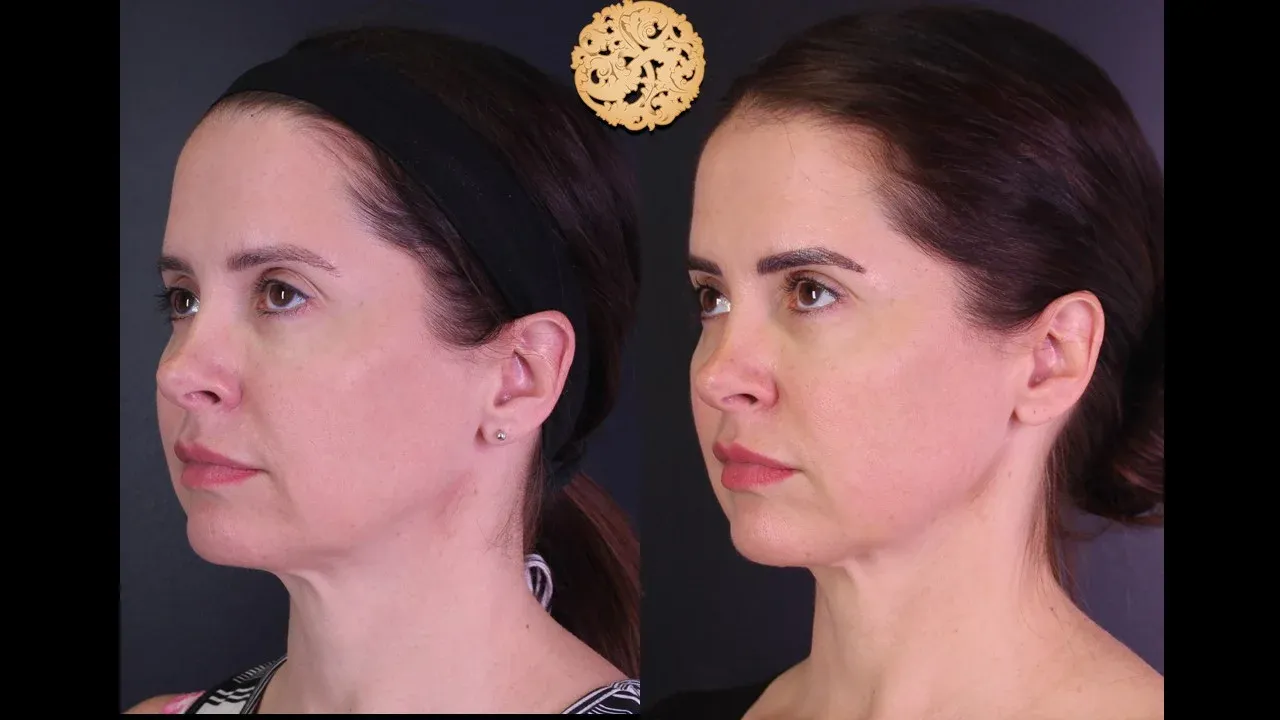 Morpheus8 Before & After