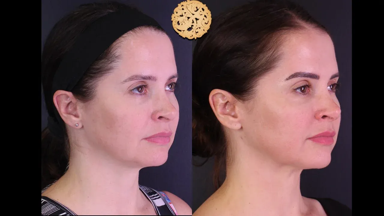 Morpheus8 Before & After