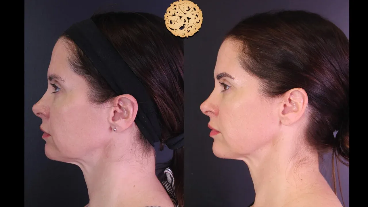 Morpheus8 Before & After