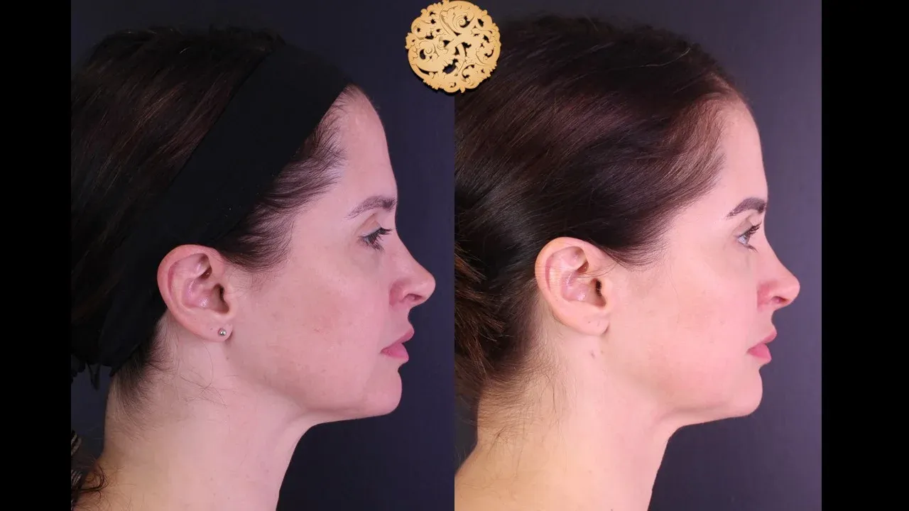 Morpheus8 Before & After