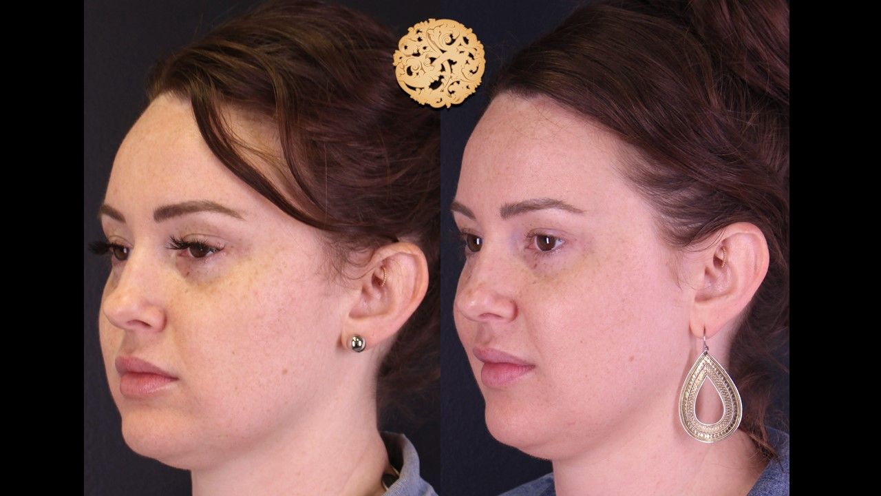 Dermal Infusion Before & After