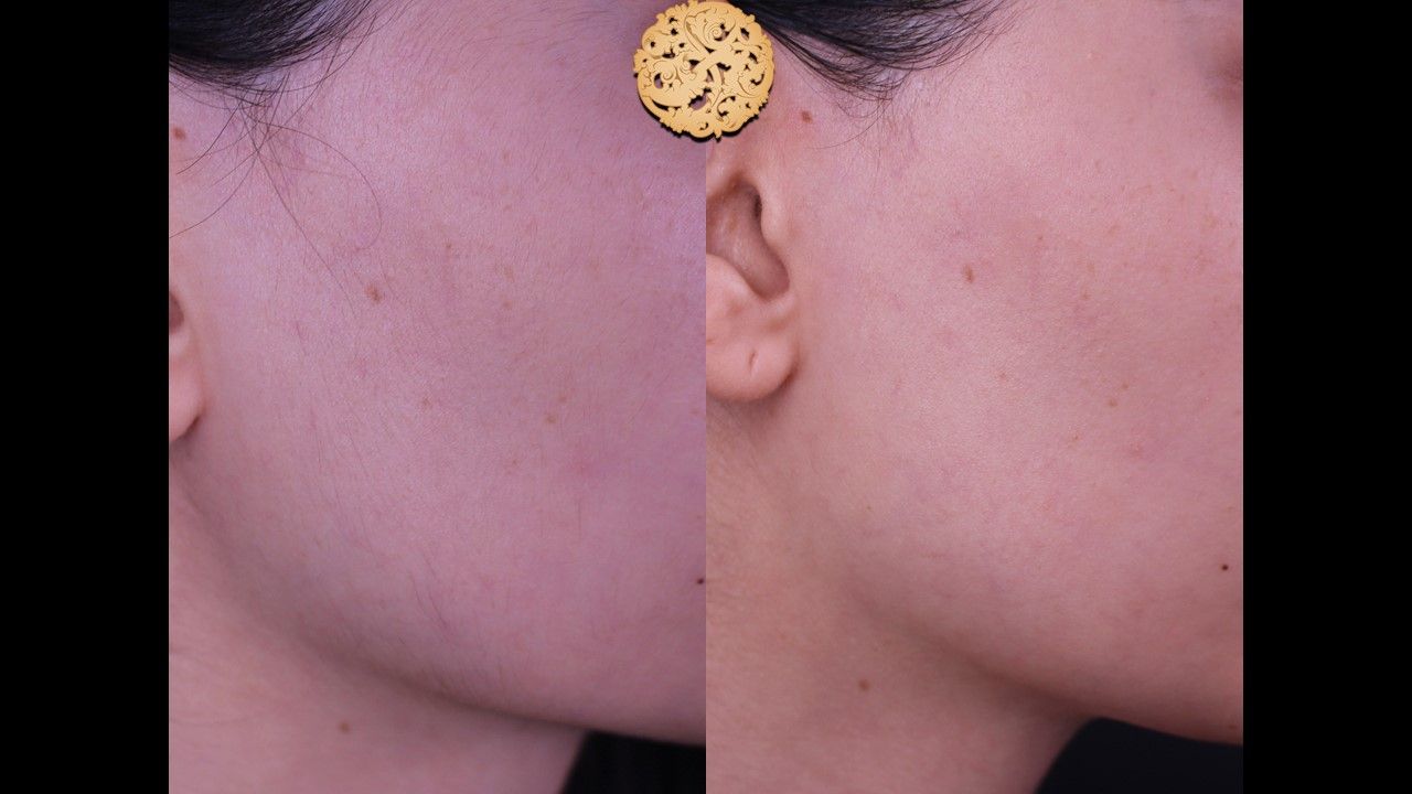 Dermal Infusion Before & After