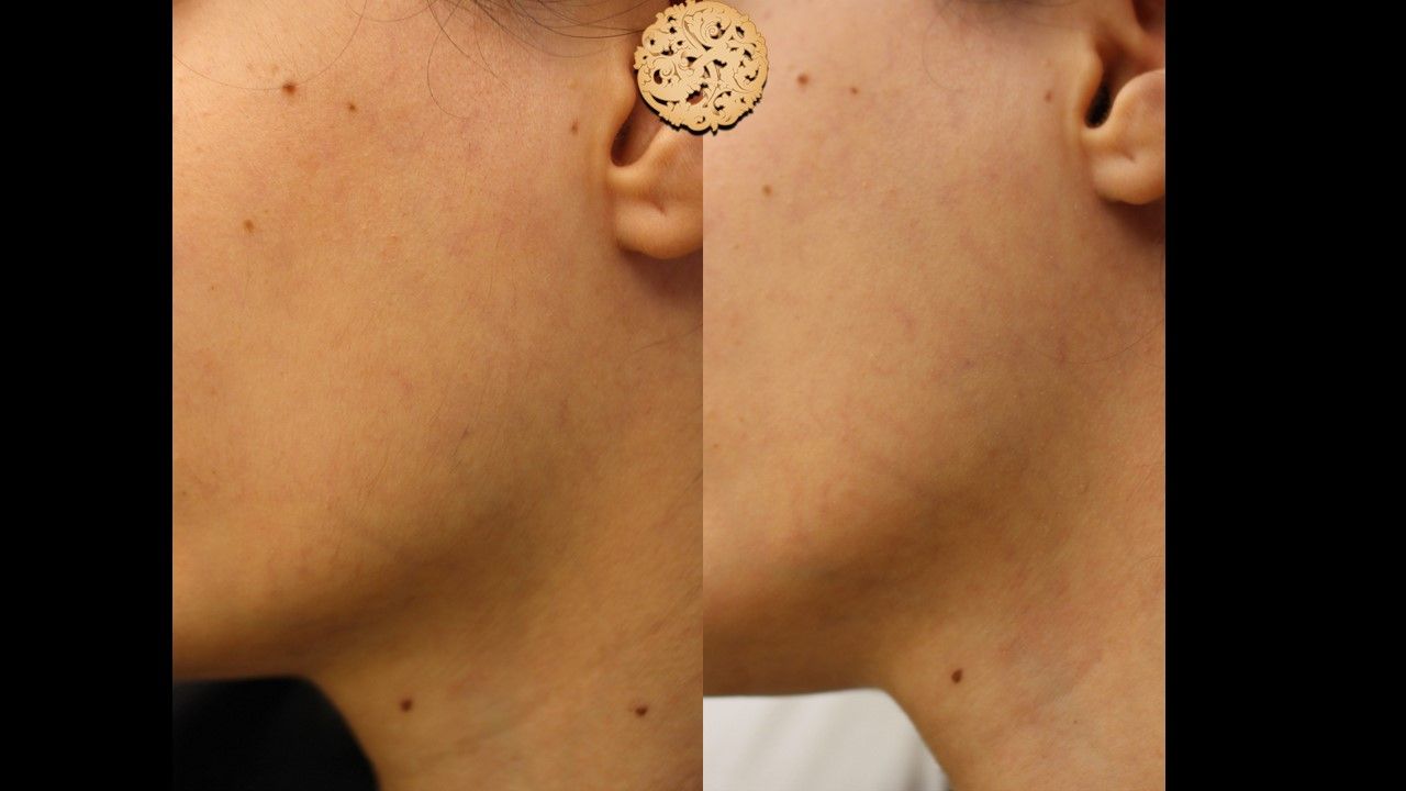 Dermal Infusion Before & After