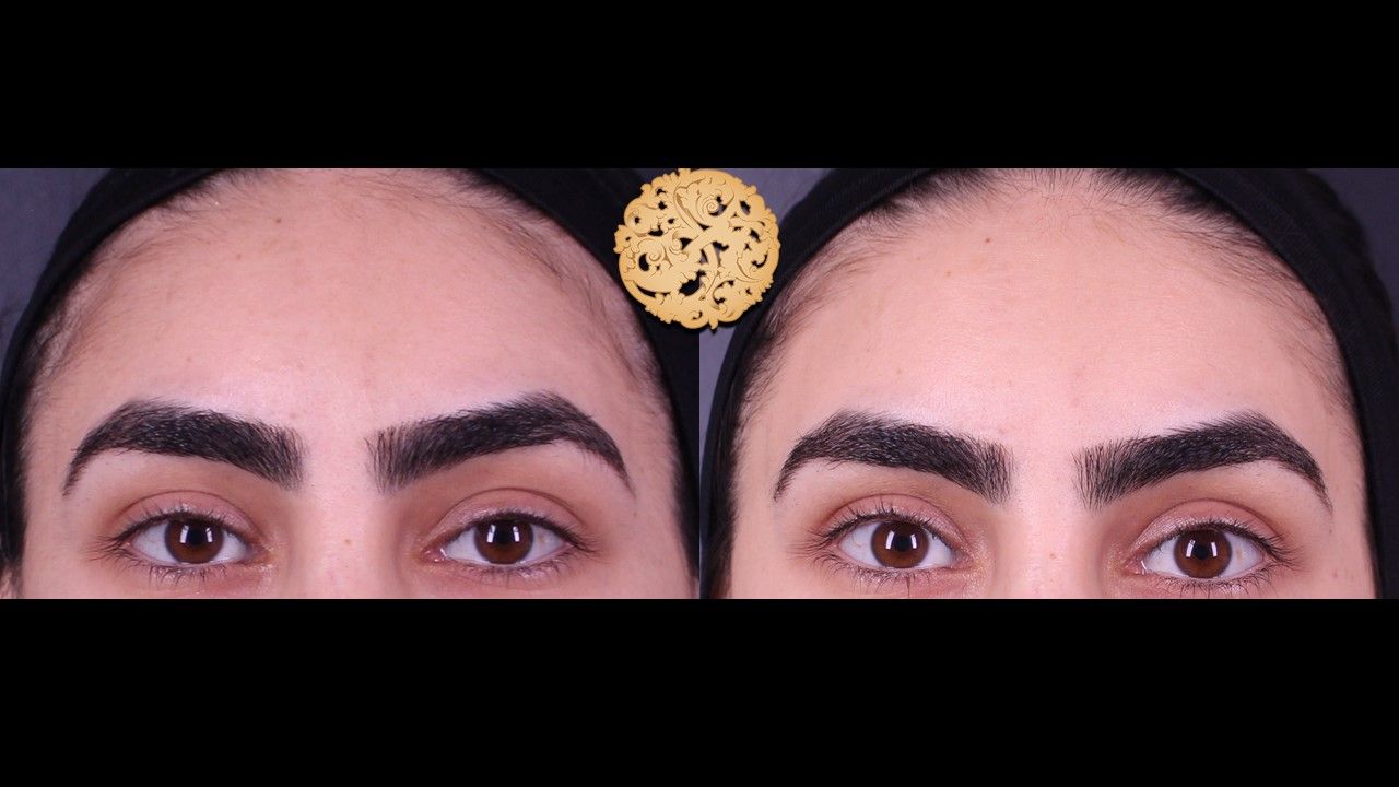 Dermal Infusion Before & After