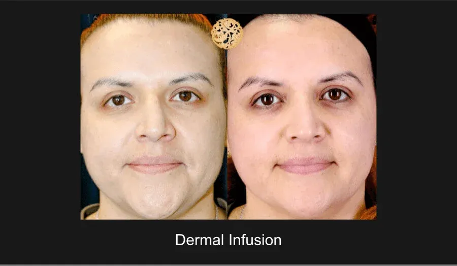 Dermal Infusion Before & After