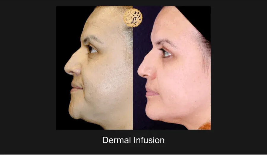 Dermal Infusion Before & After