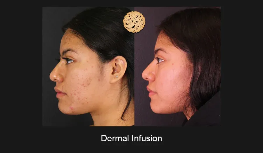 Dermal Infusion Before & After
