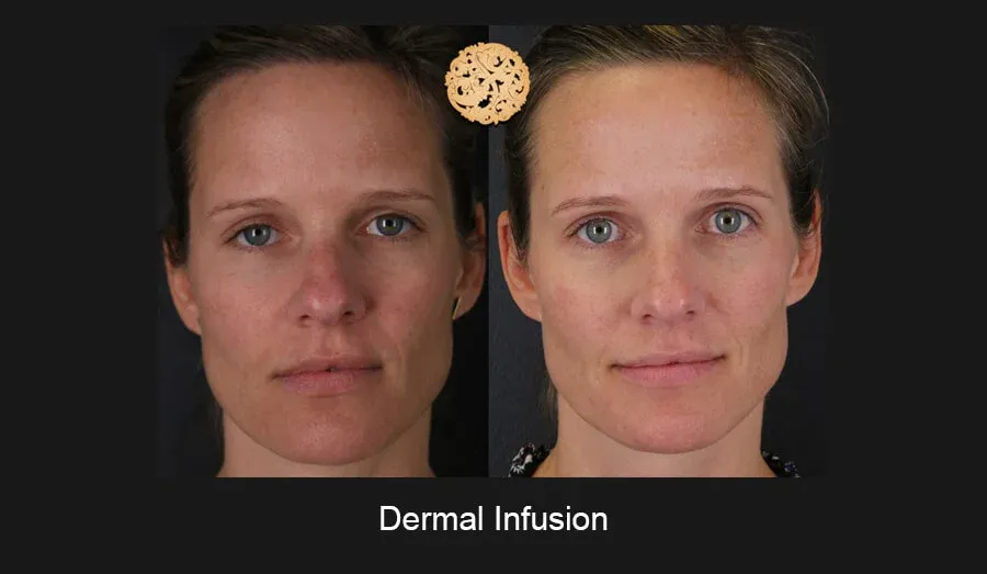 Dermal Infusion Before & After