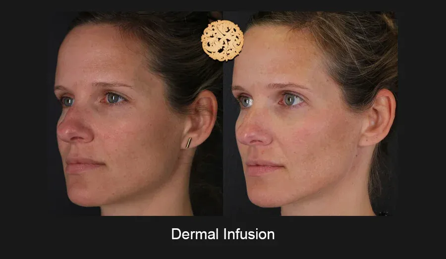 Dermal Infusion Before & After