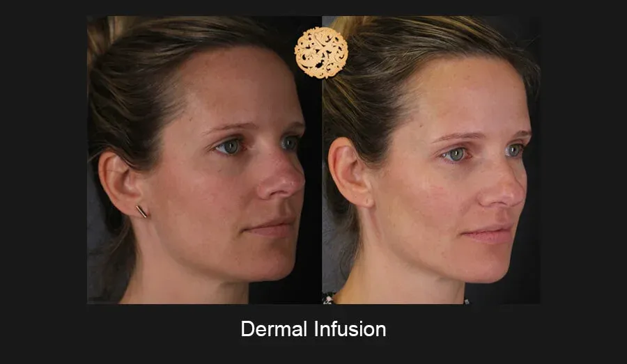 Dermal Infusion Before & After