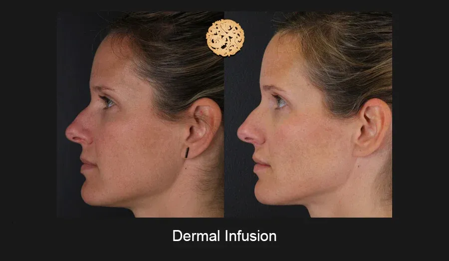 Dermal Infusion Before & After