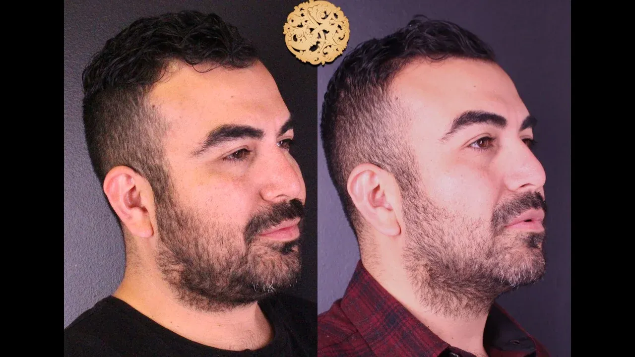 Dermal Infusion Before & After