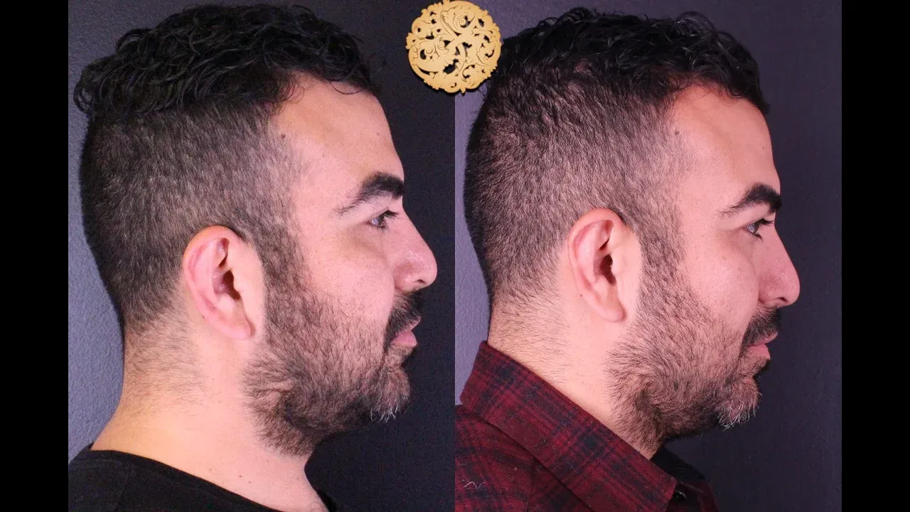 Dermal Infusion Before & After