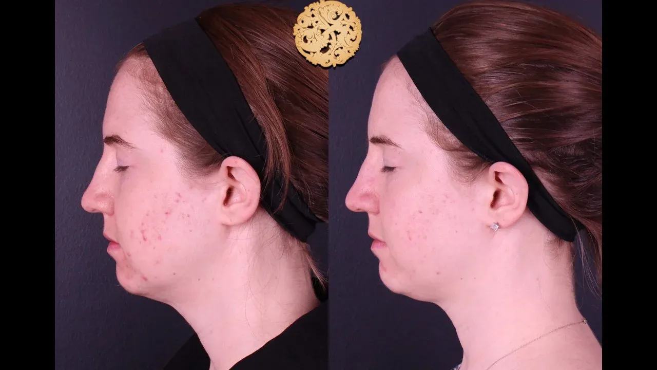 Dermal Infusion Before & After