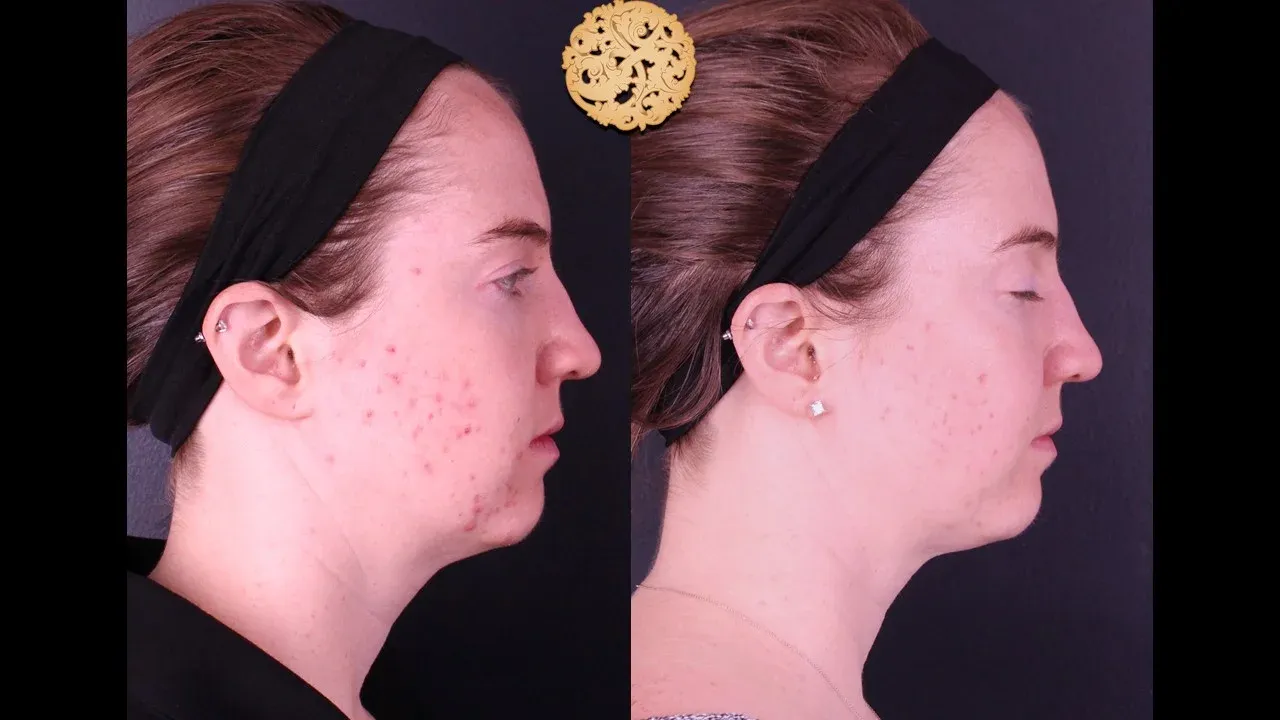 Dermal Infusion Before & After