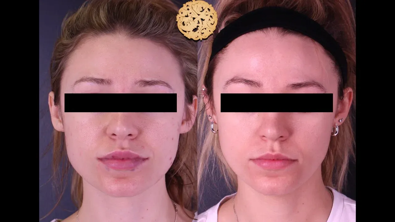 Dermal Infusion Before & After