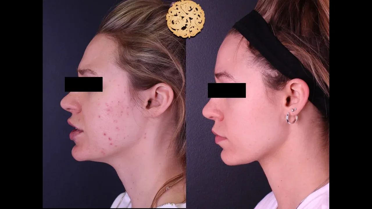 Dermal Infusion Before & After