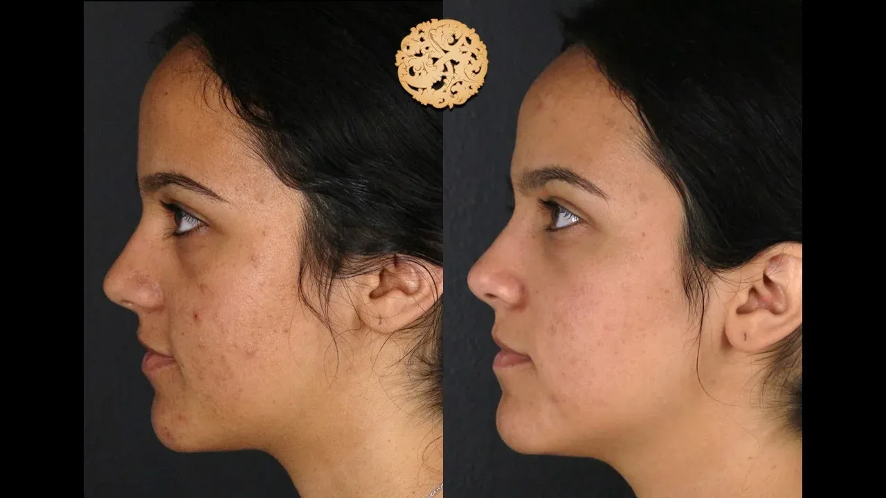Dermal Infusion Before & After