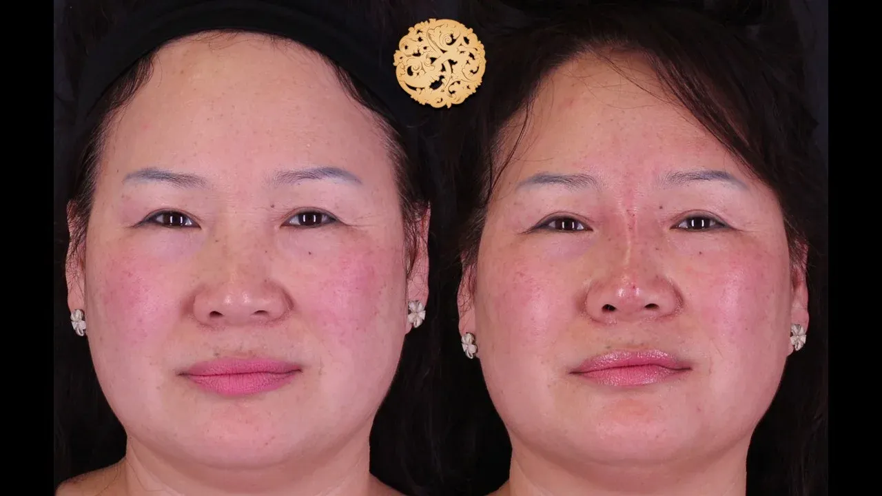 Dermal Infusion Before & After