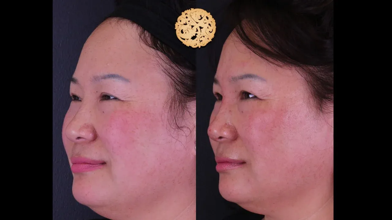 Dermal Infusion Before & After