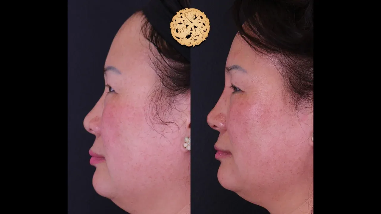 Dermal Infusion Before & After