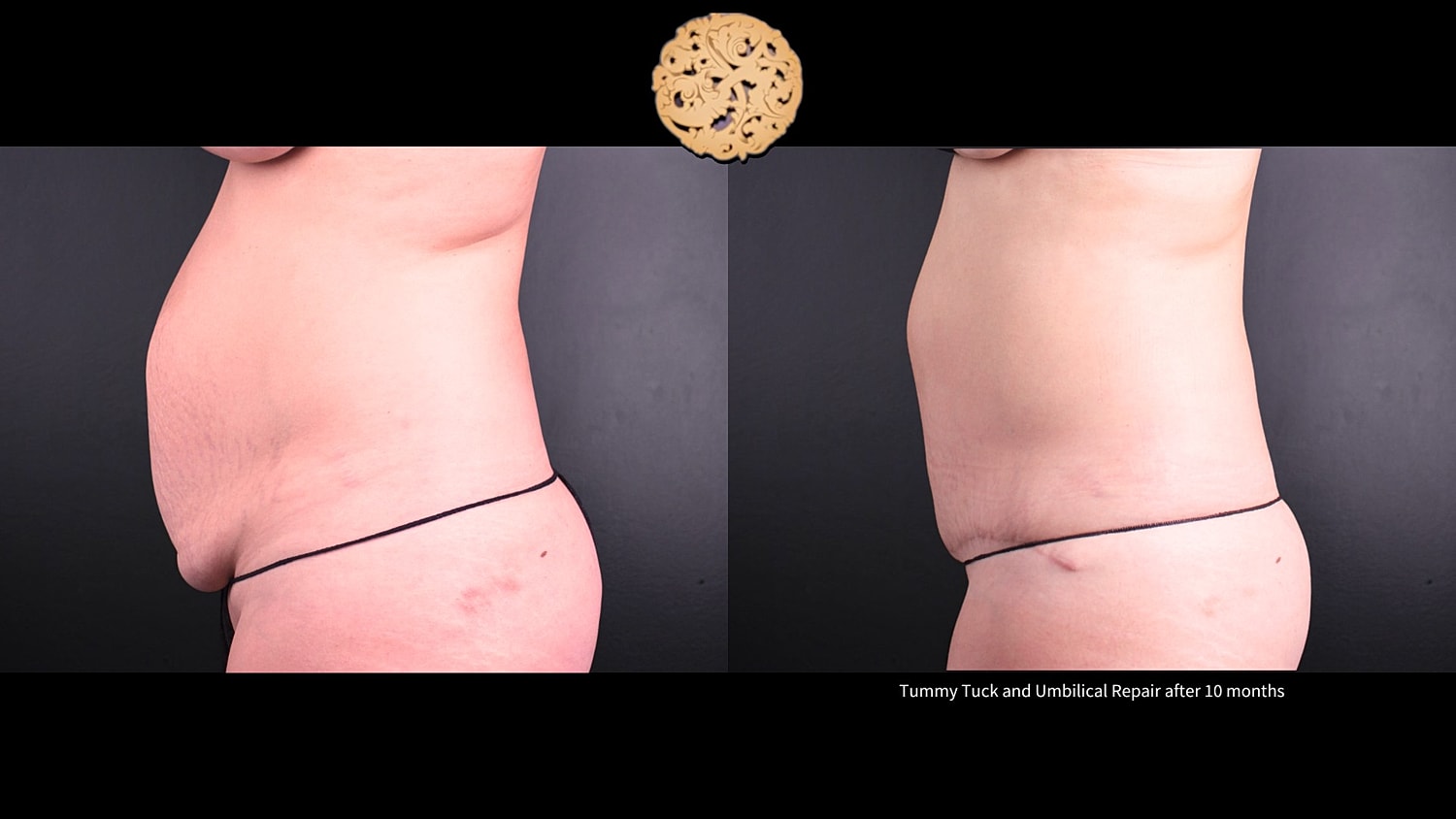 Umbilical Repair Before & After