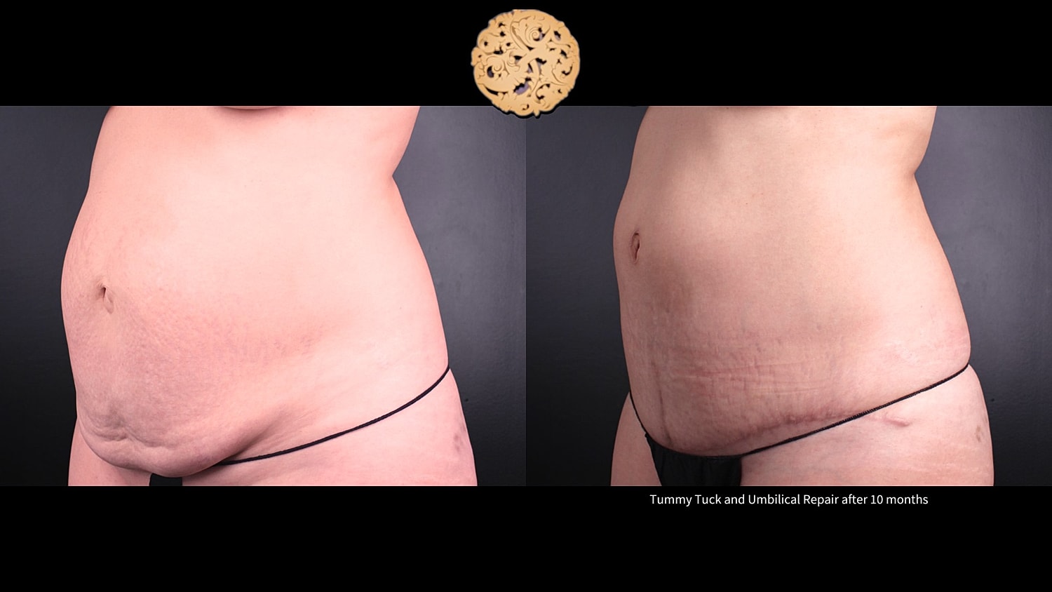 Umbilical Repair Before & After
