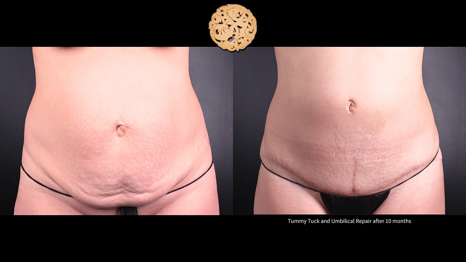 Umbilical Repair Before & After