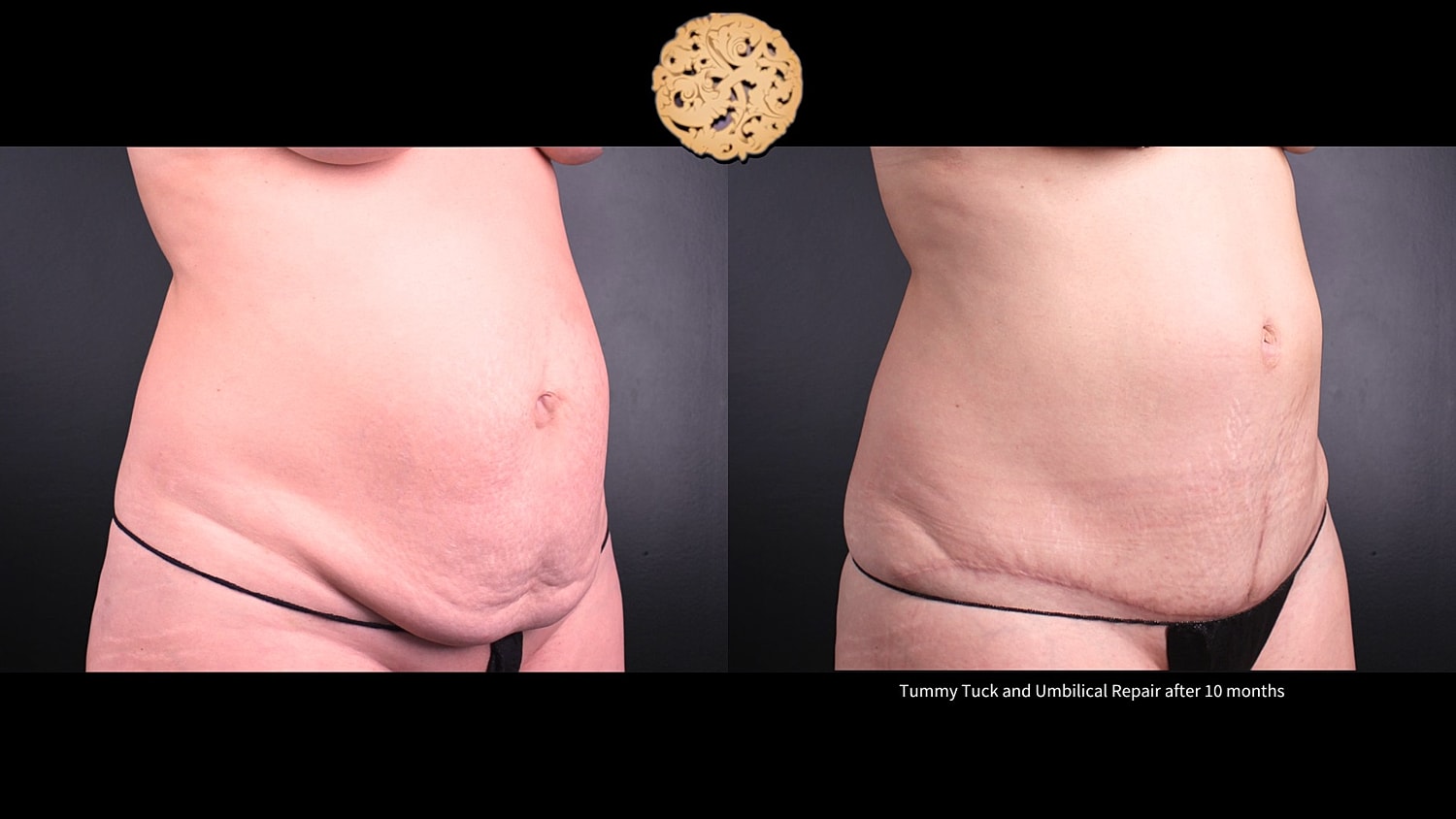 Umbilical Repair Before & After
