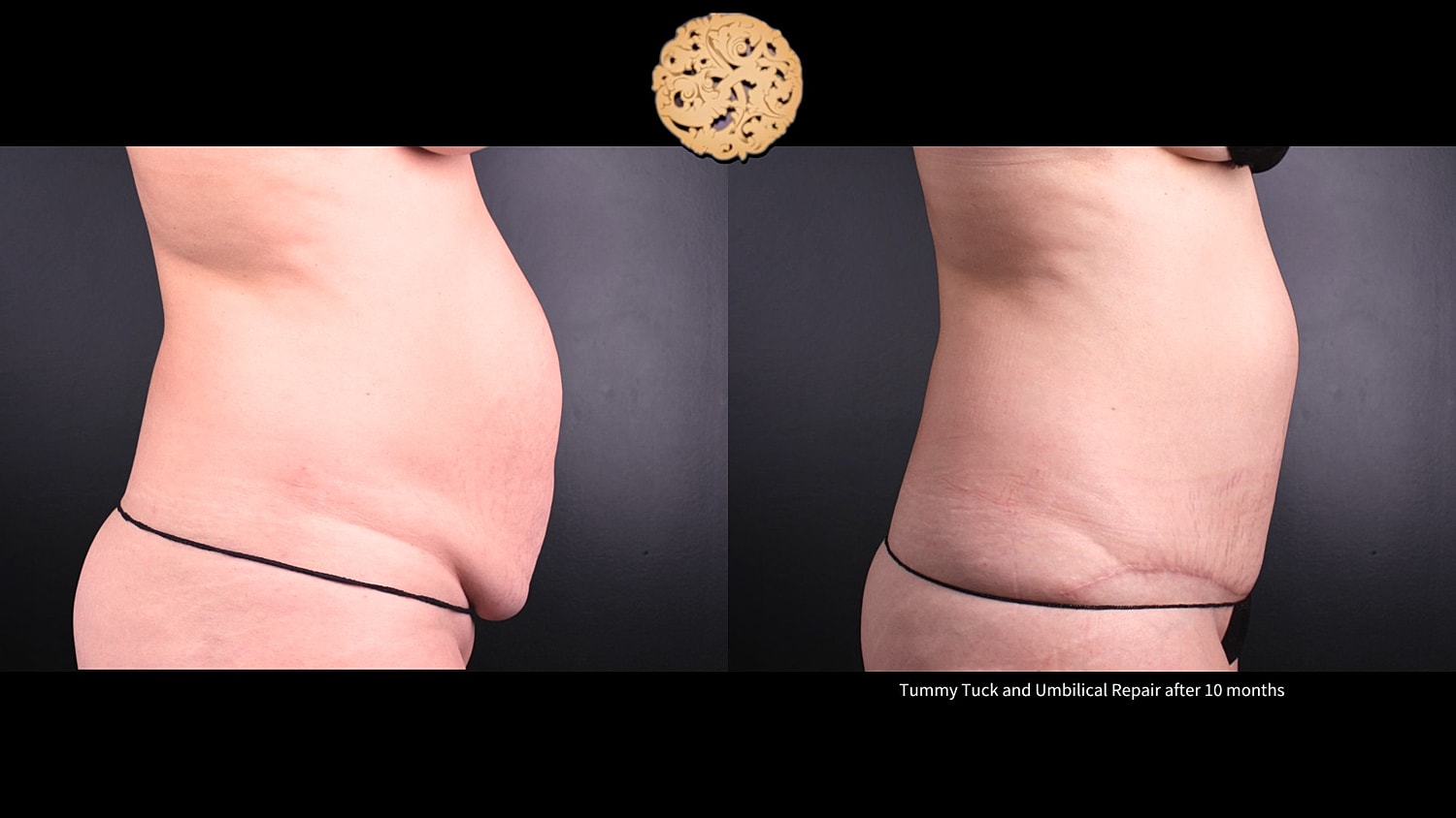 Umbilical Repair Before & After
