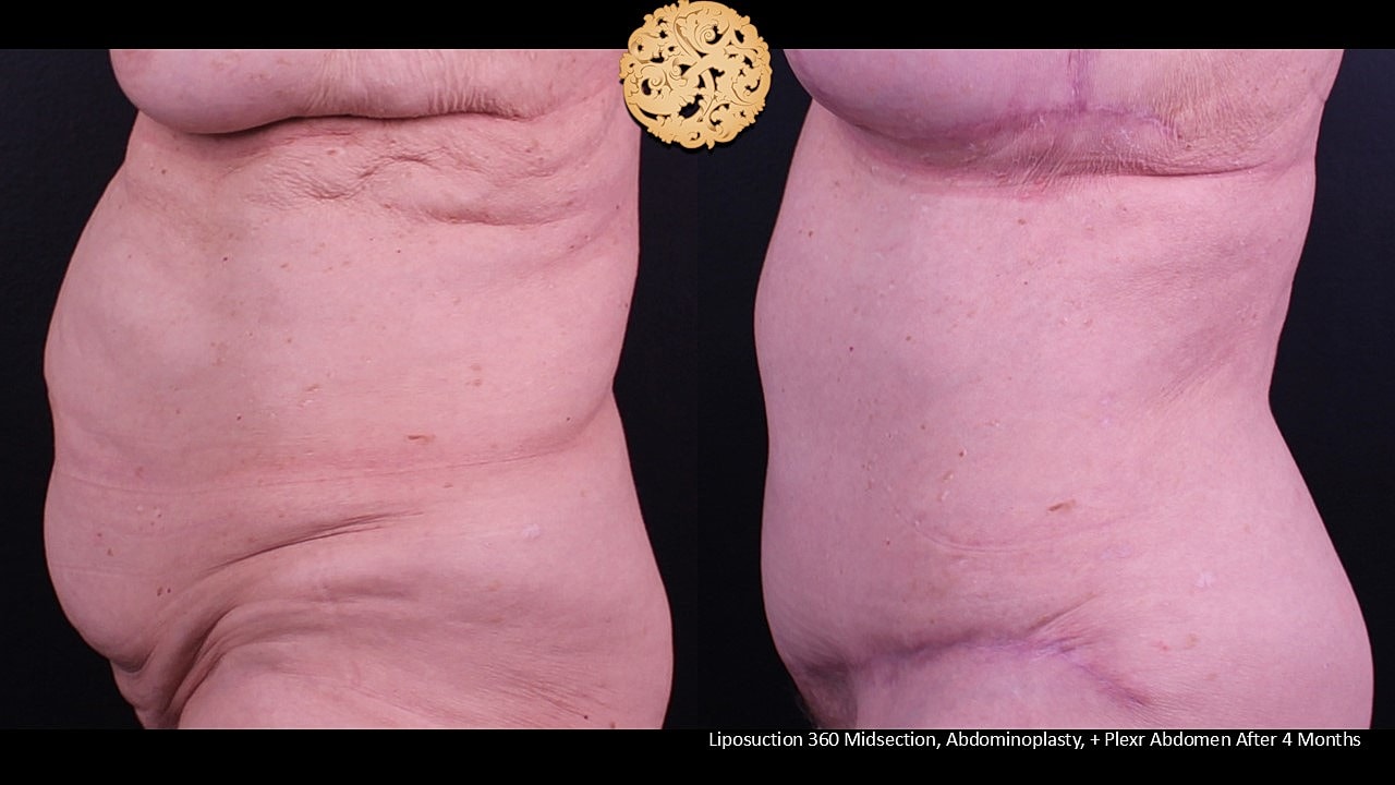 Plexr Before & After